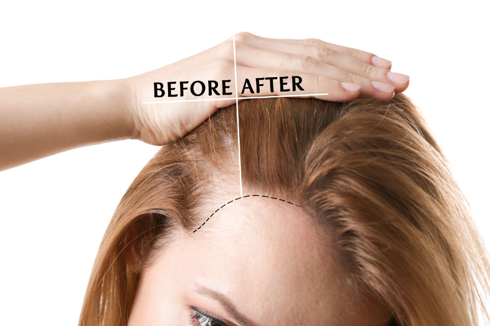 What Is Female Pattern Baldness and Can It Be Treated? 1 What Is Female Pattern Baldness and Can It Be Treated? 1