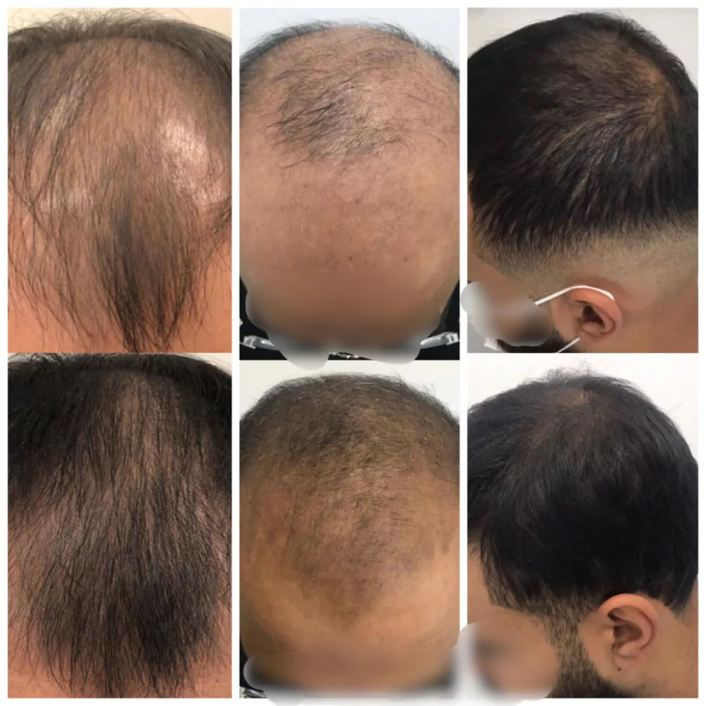 Male-PRP-Before-and-After-Photo-14