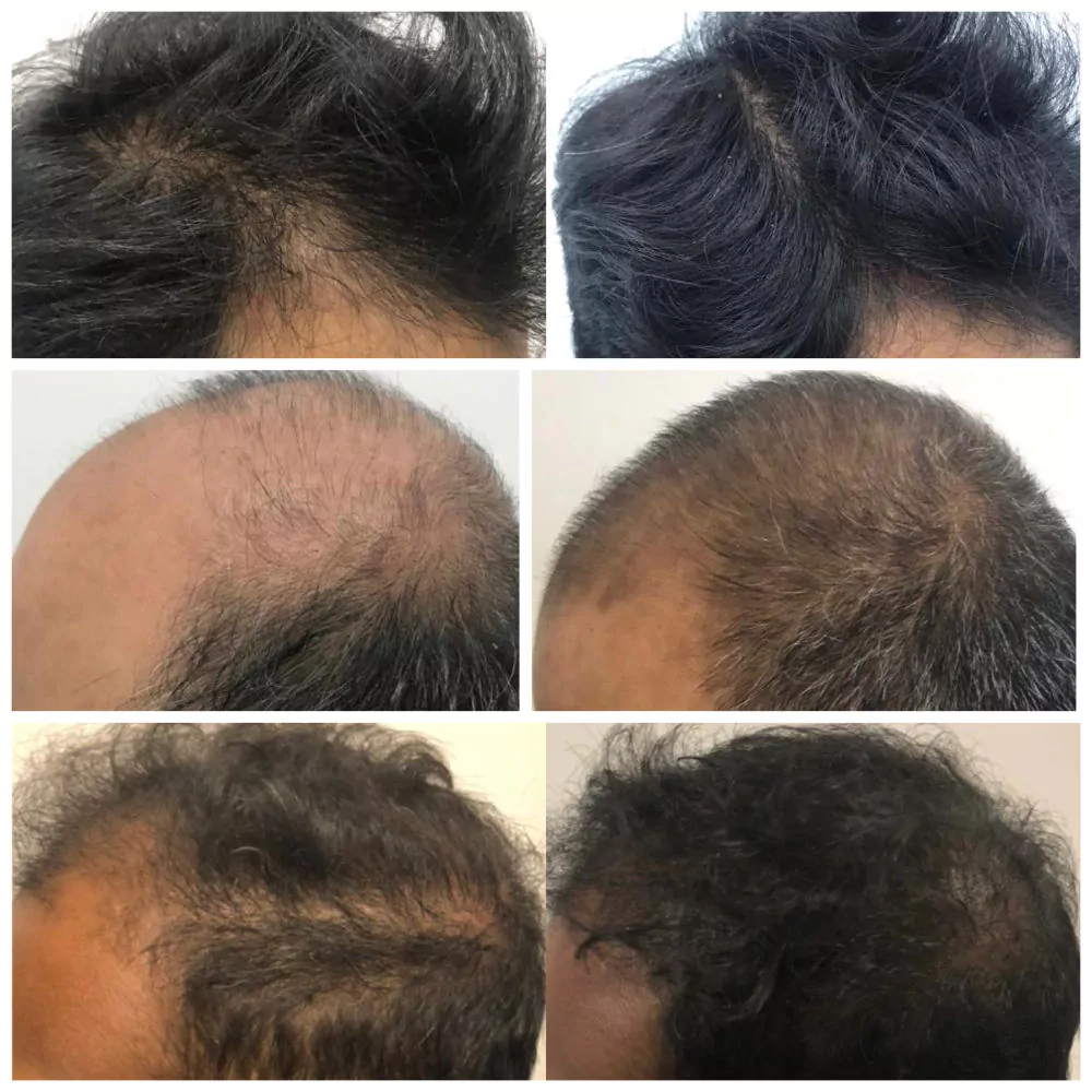 Male-PRP-Before-and-After-Photo-29