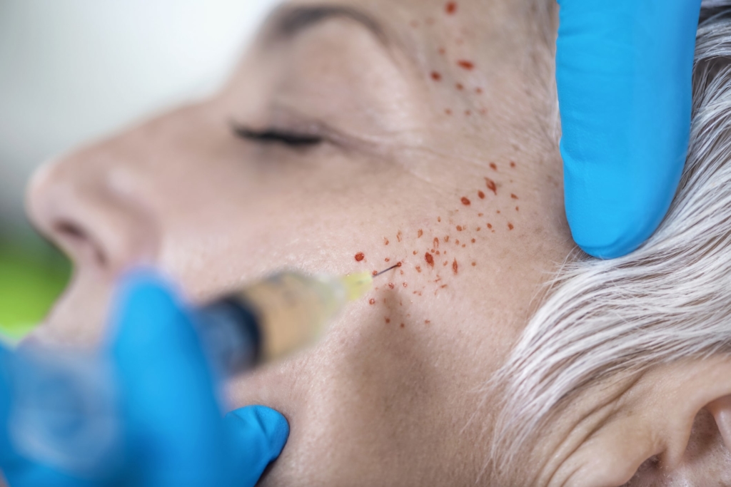 What is PRP skin treatment? 7 What is PRP skin treatment? 7