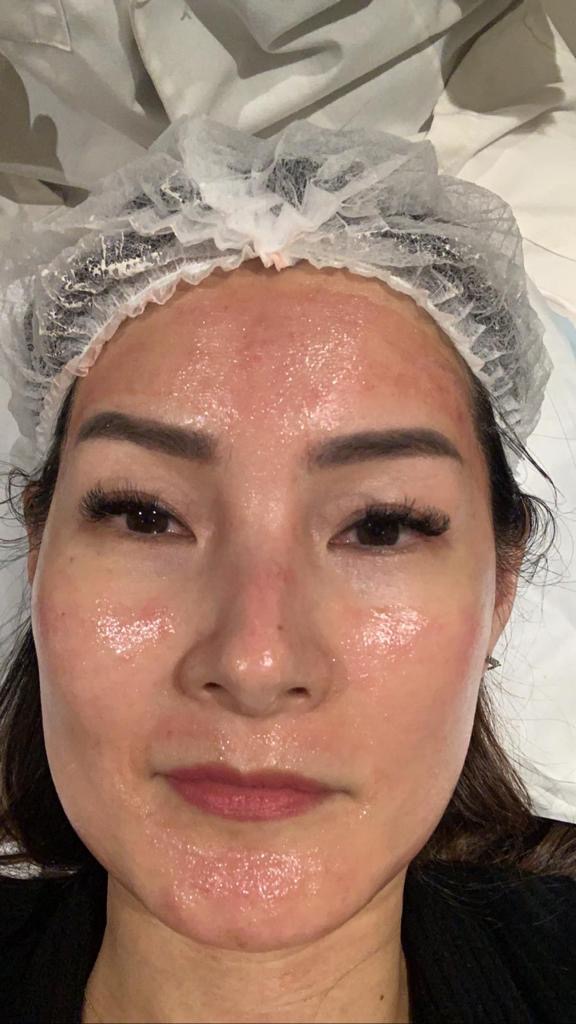 What is PRP skin treatment? 3 What is PRP skin treatment? 3